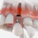 Dental Implants Penrith