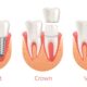 Get a Perfect Smile with Same-Day Crowns in Las Vegas!