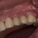 Wisdom teeth removal Tijuana