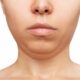 Neck Fat Solutions – What You Need to Know Today