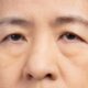 Sudden Droopy Eyelids? Learn What It Means & What to Do