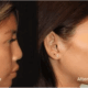 Book the Botox Online Today