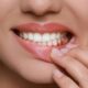 Advanced Gum Disease Treatment for Healthier Gums