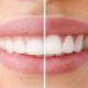 Laser Gum Disease Treatment Colorado Dental Wellness Center