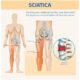 Chiropractic Treatment for Sciatica | Targeted Pain Relief