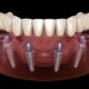 All on 4 dental implants Tijuana Mexico