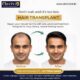 Best Hair Transplant Clinic in Electronic City | Clarivskin.in