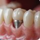 Dental Implants Penrith