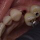 Dental crowns in Tijuana