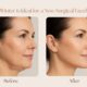 Why Winter Is Ideal for a Non-Surgical Facelift in Sydney