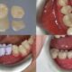 Same Day CEREC Crowns in Marlow for Fast Tooth Restoration